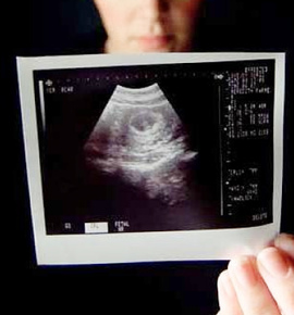 Хромосомные нарушения как причина спонтанных абортов